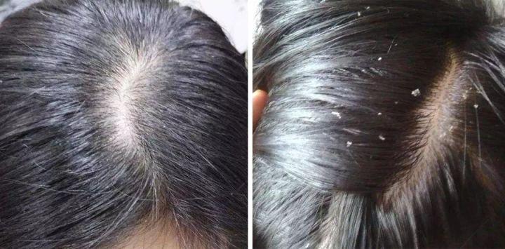 头发爱出油还脱发怎么办？—— 科学护理，重拾秀发活力